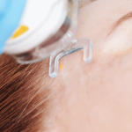 Safe Fractional Laser Option for Brighter Skin by Fall Near Takoma Park MD